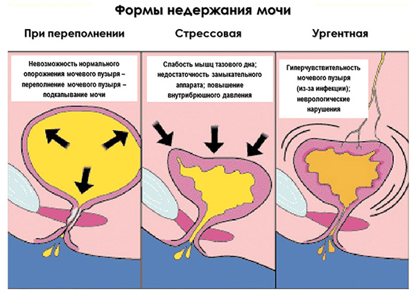 Формы недержания мочи