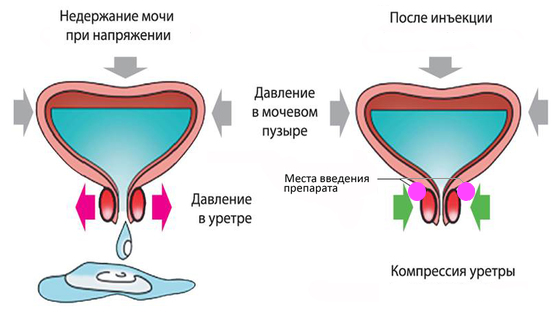 Коррекция недержания мочи с помощью инъекций