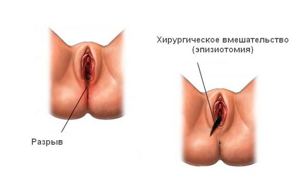 ЭпизиотомиЯ